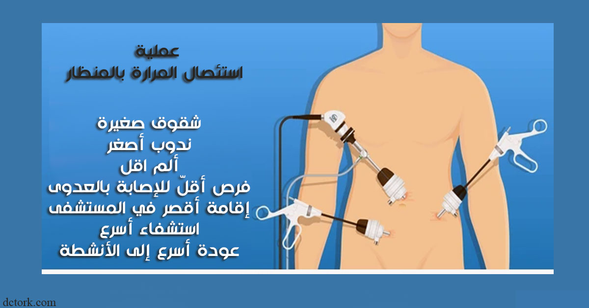 عملية استئصال المرارة بالمنظار