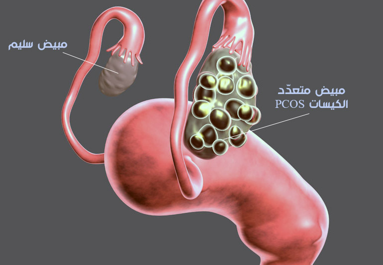 متلازمة تكيّس المبايض PCOS