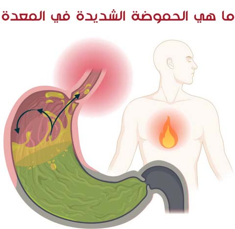 أنواع الحموضة المعدية