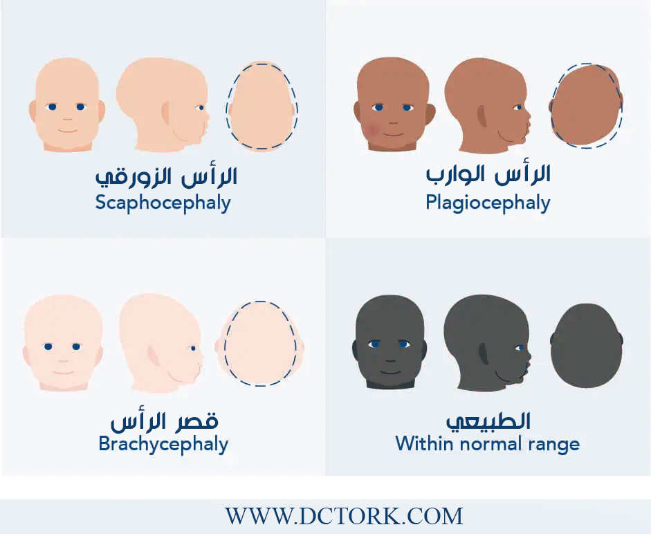  أسباب ولادة طفلٍ بشكل رأسٍ غير طبيعي 